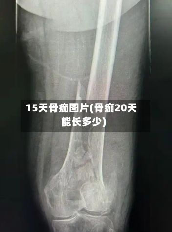 15天骨痂图片(骨痂20天能长多少)